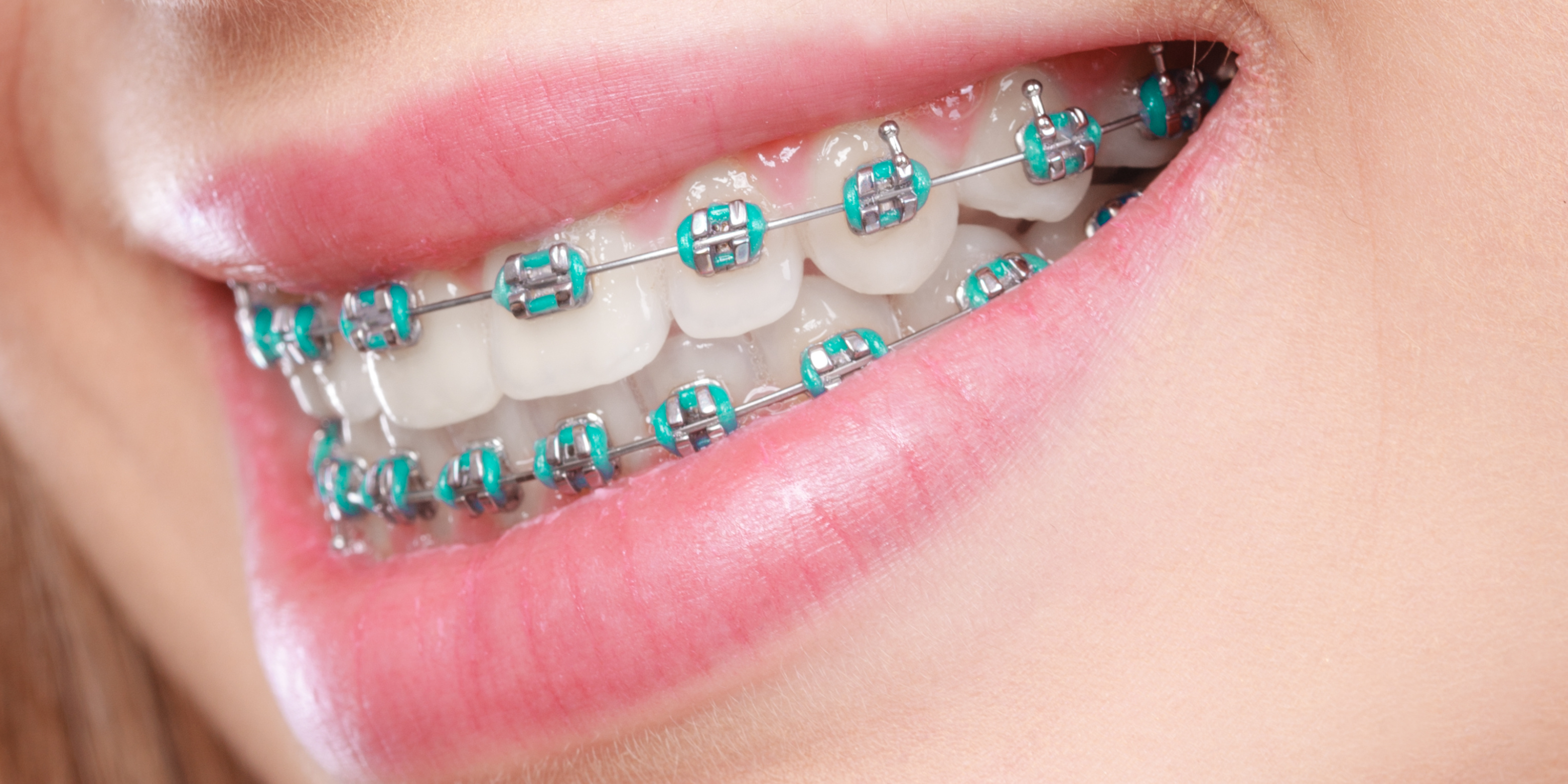 TODOS LOS BRACKETS